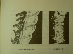 대장벽의 게실과 S자 결장의 게실. 게실은 장의 염증 부위 출혈과 정체된 변이 말려 들어간 만들어진다고 한다. 